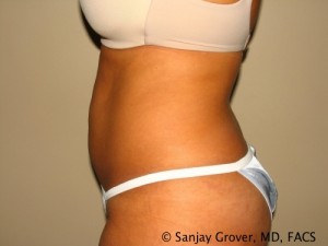 Liposuction Before and After 61 | Sanjay Grover MD FACS