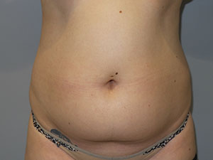 Liposuction Before and After 06 | Sanjay Grover MD FACS