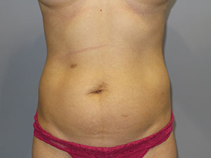 Liposuction Before and After 63 | Sanjay Grover MD FACS