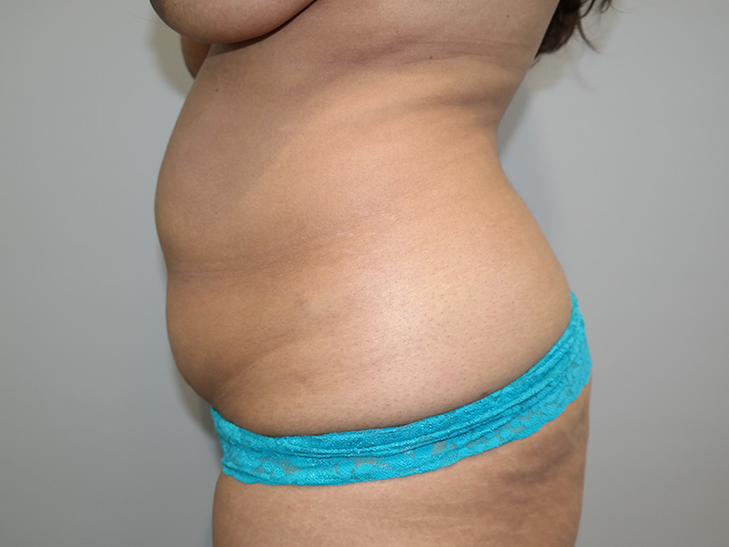 Tummy Tuck Before and After 04 | Sanjay Grover MD FACS