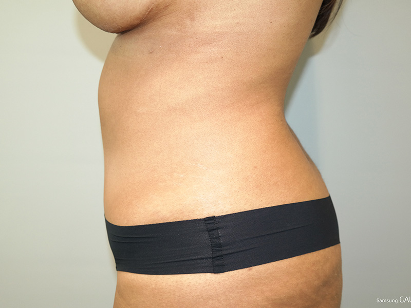 Tummy Tuck Before and After 04 | Sanjay Grover MD FACS