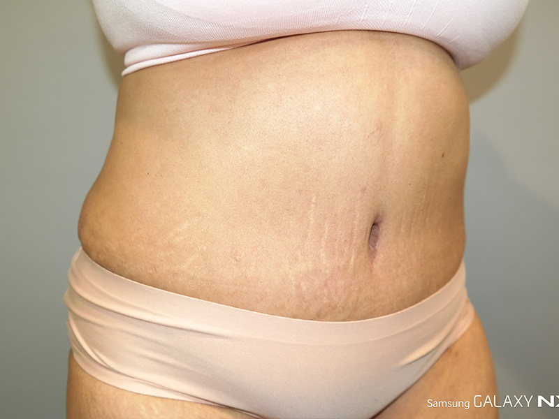 Tummy Tuck Before and After 05 | Sanjay Grover MD FACS