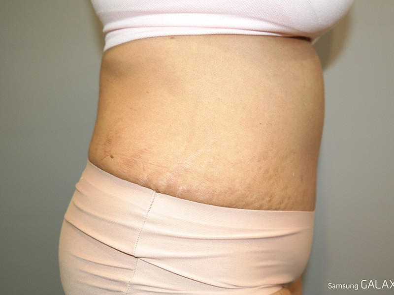 Tummy Tuck Before and After 05 | Sanjay Grover MD FACS