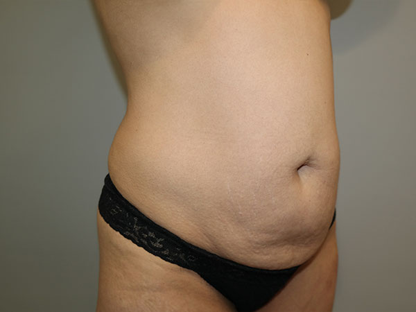 Tummy Tuck Before and After 06 | Sanjay Grover MD FACS