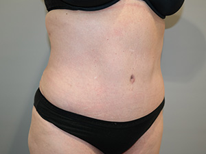 Tummy Tuck Before and After 08 | Sanjay Grover MD FACS