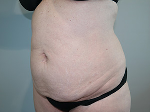 Tummy Tuck Before and After 08 | Sanjay Grover MD FACS