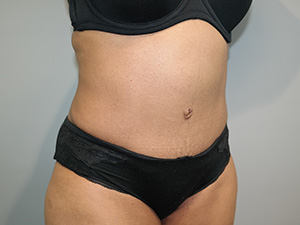 Tummy Tuck Before and After 09 | Sanjay Grover MD FACS