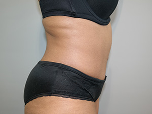 Tummy Tuck Before and After 09 | Sanjay Grover MD FACS