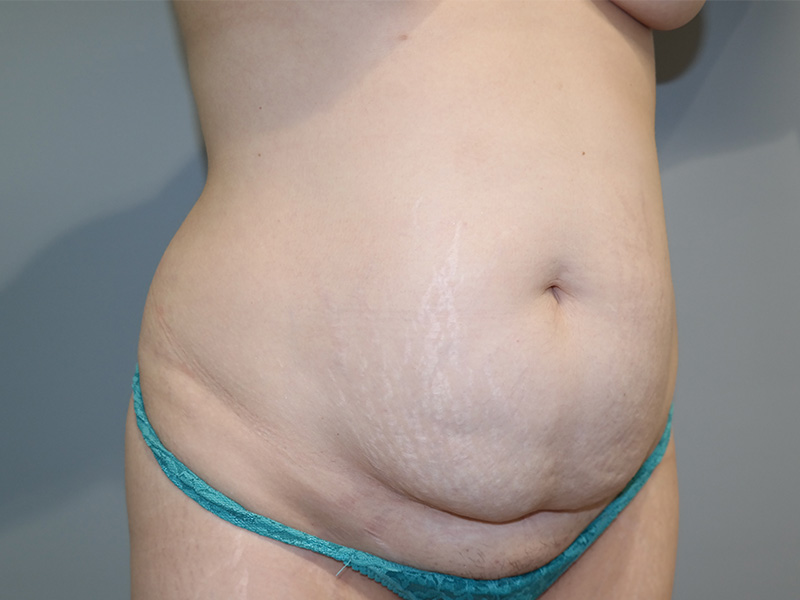 Tummy Tuck Before and After 10 | Sanjay Grover MD FACS