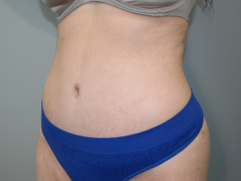 Tummy Tuck Before and After 10 | Sanjay Grover MD FACS