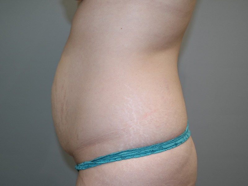 Tummy Tuck Before and After 10 | Sanjay Grover MD FACS