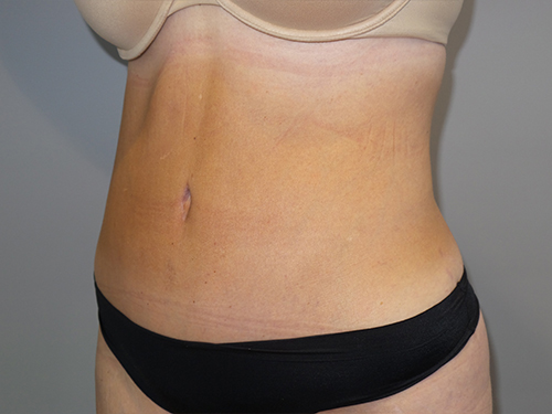 Tummy Tuck Before and After 100 | Sanjay Grover MD FACS