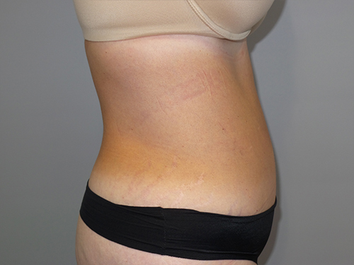 Tummy Tuck Before and After 100 | Sanjay Grover MD FACS