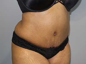 Tummy Tuck Before and After 101 | Sanjay Grover MD FACS