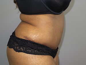 Tummy Tuck Before and After 101 | Sanjay Grover MD FACS