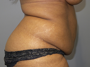 Tummy Tuck Before and After 101 | Sanjay Grover MD FACS