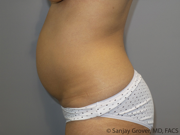 Tummy Tuck Before and After 102 | Sanjay Grover MD FACS