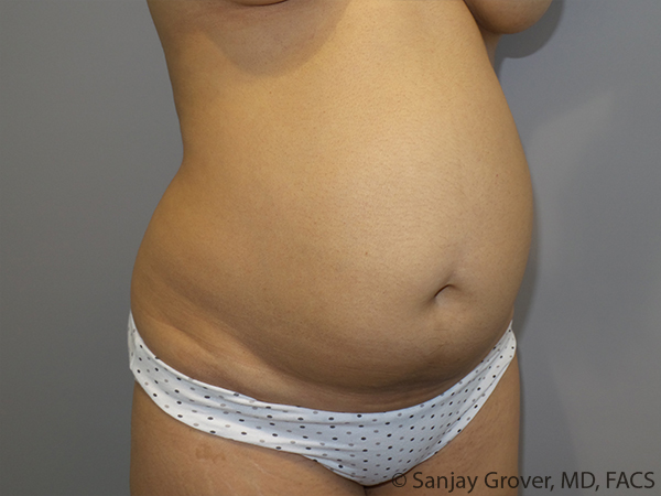 Tummy Tuck Before and After 102 | Sanjay Grover MD FACS