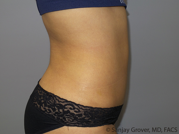 Tummy Tuck Before and After 102 | Sanjay Grover MD FACS