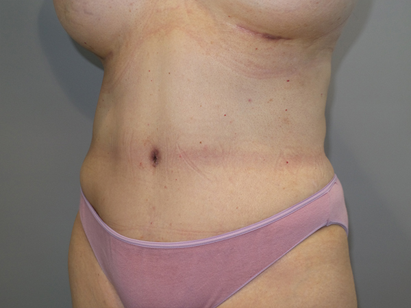 Tummy Tuck Before and After 103 | Sanjay Grover MD FACS