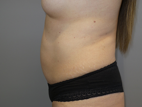 Tummy Tuck Before and After 103 | Sanjay Grover MD FACS