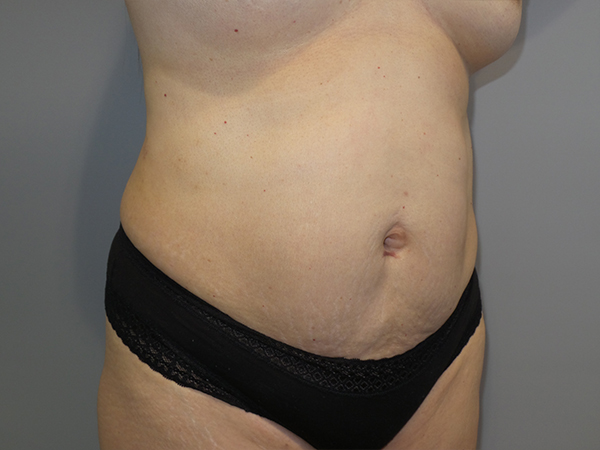 Tummy Tuck Before and After 103 | Sanjay Grover MD FACS