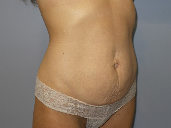 Tummy Tuck Before and After 106 | Sanjay Grover MD FACS