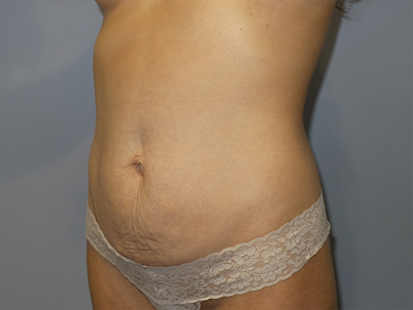 Tummy Tuck Before and After 106 | Sanjay Grover MD FACS