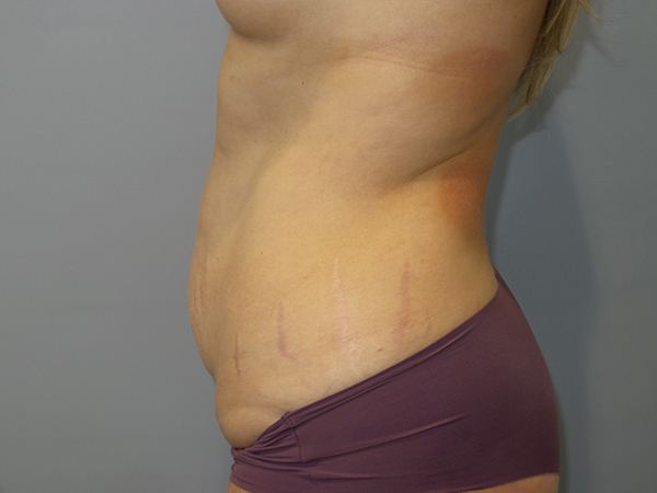 Tummy Tuck Before and After 107 | Sanjay Grover MD FACS