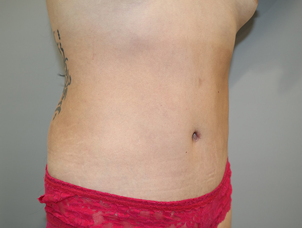 Tummy Tuck Before and After 108 | Sanjay Grover MD FACS