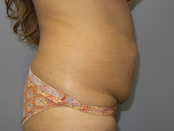 Tummy Tuck Before and After 109 | Sanjay Grover MD FACS