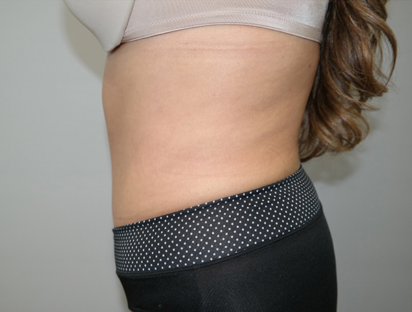 Tummy Tuck Before and After 109 | Sanjay Grover MD FACS