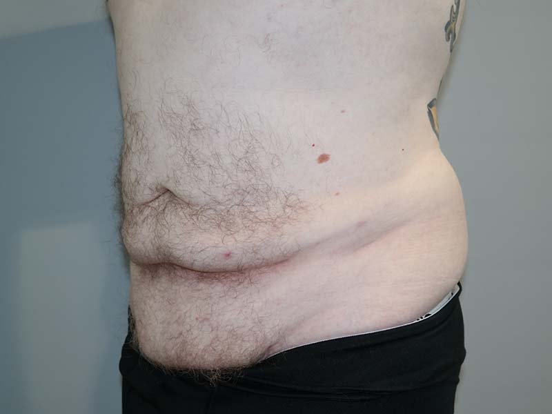 Tummy Tuck Before and After 11 | Sanjay Grover MD FACS