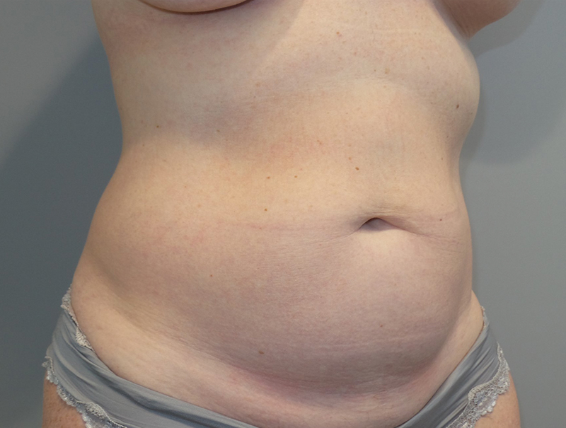 Tummy Tuck Before and After 110 | Sanjay Grover MD FACS