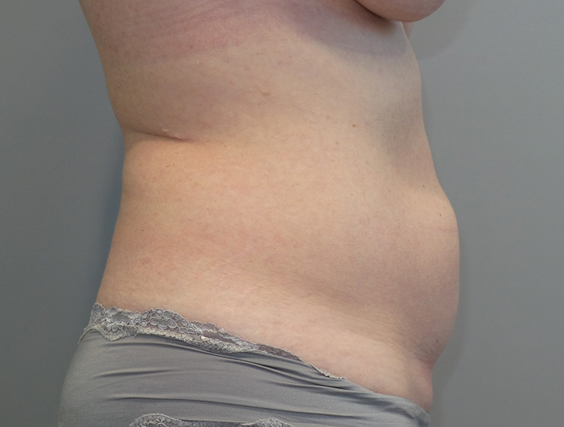 Tummy Tuck Before and After 110 | Sanjay Grover MD FACS