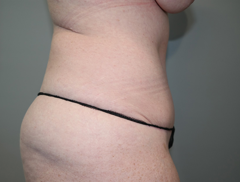 Tummy Tuck Before and After 110 | Sanjay Grover MD FACS