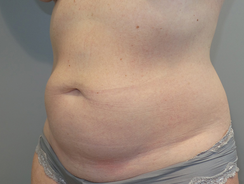 Tummy Tuck Before and After 110 | Sanjay Grover MD FACS