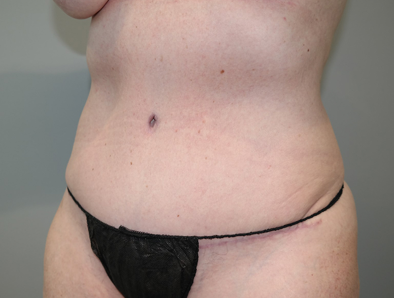 Tummy Tuck Before and After 110 | Sanjay Grover MD FACS