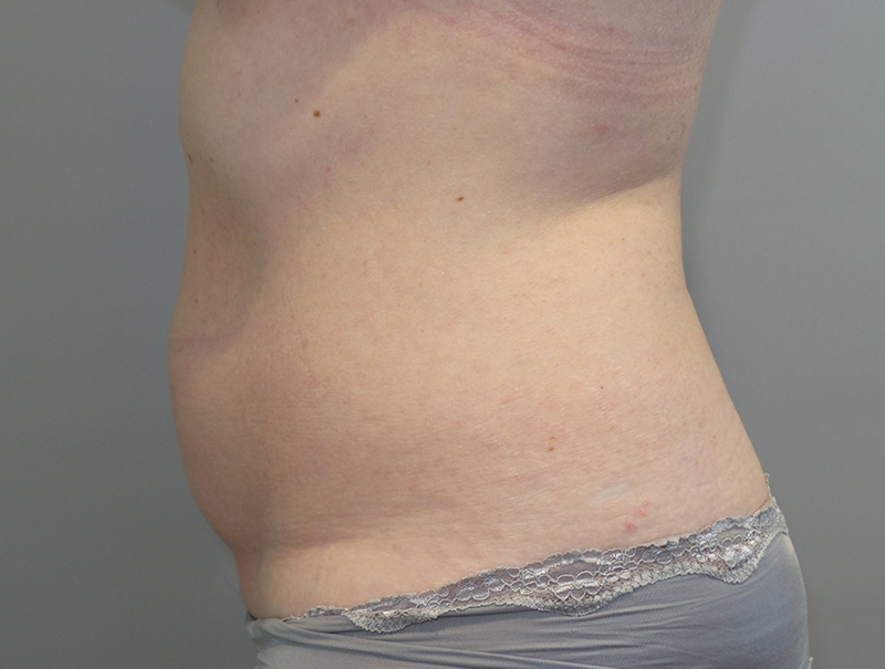 Tummy Tuck Before and After 110 | Sanjay Grover MD FACS