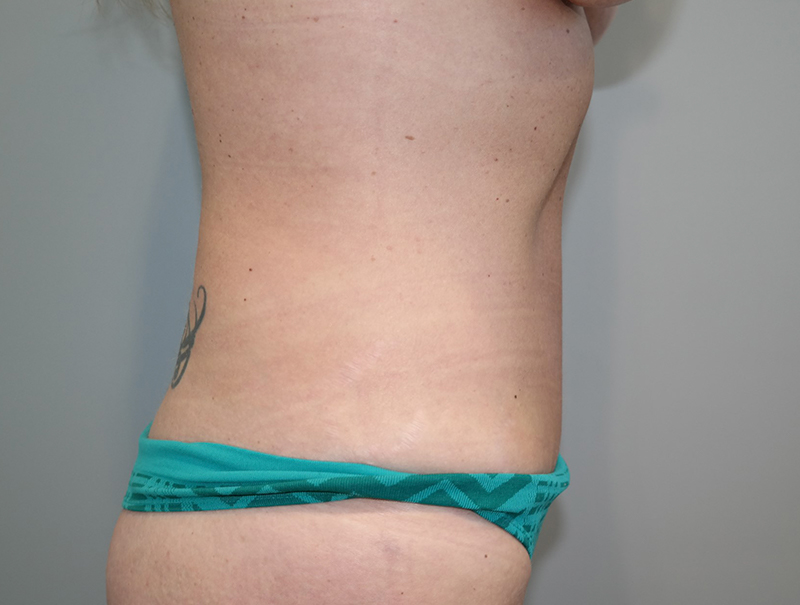 Tummy Tuck Before and After 111 | Sanjay Grover MD FACS