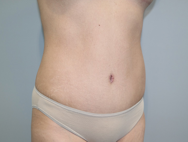 Tummy Tuck Before and After 112 | Sanjay Grover MD FACS