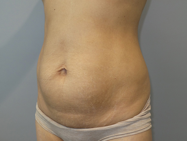 Tummy Tuck Before and After 112 | Sanjay Grover MD FACS