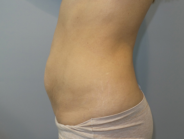 Tummy Tuck Before and After 112 | Sanjay Grover MD FACS