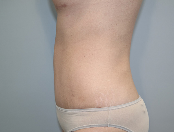 Tummy Tuck Before and After 112 | Sanjay Grover MD FACS