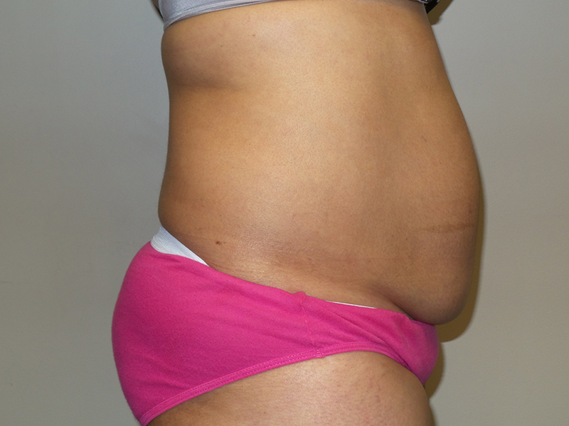 Tummy Tuck Before and After 114 | Sanjay Grover MD FACS