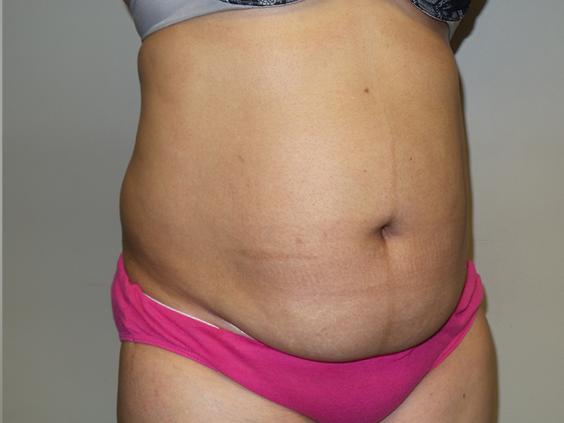 Tummy Tuck Before and After 114 | Sanjay Grover MD FACS