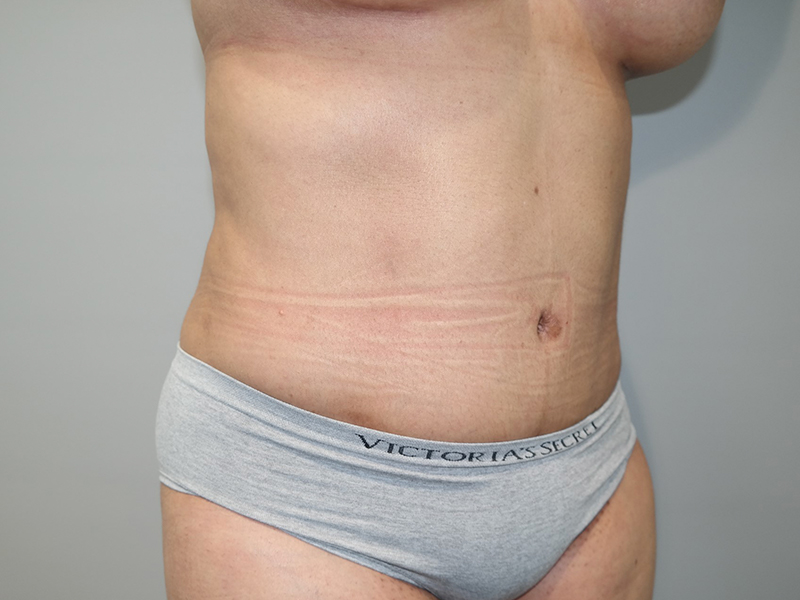 Tummy Tuck Before and After 114 | Sanjay Grover MD FACS