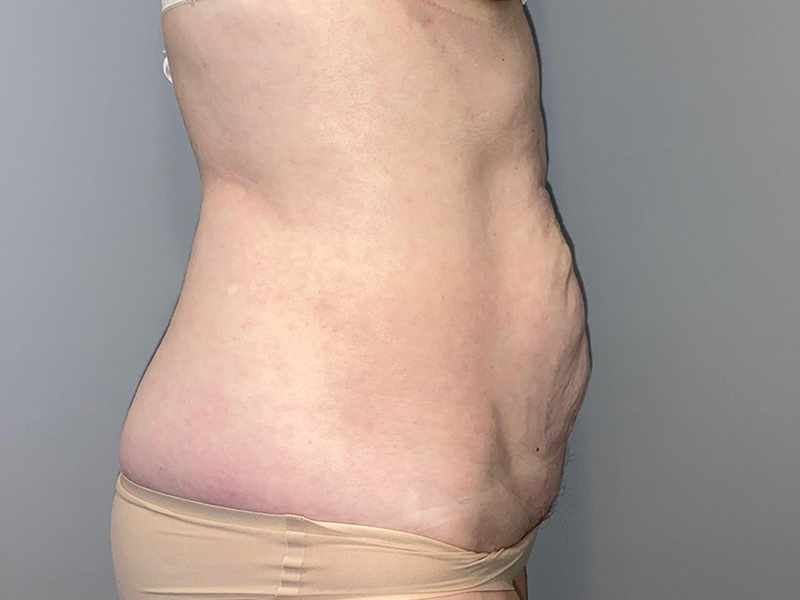 Tummy Tuck Before and After 115 | Sanjay Grover MD FACS