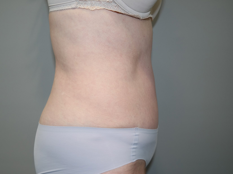 Tummy Tuck Before and After 115 | Sanjay Grover MD FACS