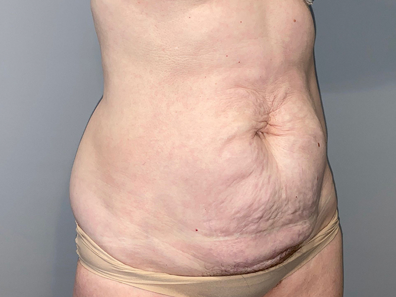 Tummy Tuck Before and After 115 | Sanjay Grover MD FACS